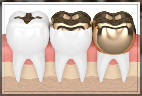 Gold Fillings: Pros and Cons - Engiomed