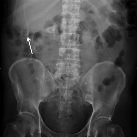 -The treatment algorithm for ventriculoperitoneal )VP( shunt-associated ...