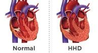 What is "hypertensive heart disease"? Ex-lawyer died of it in his jail ...