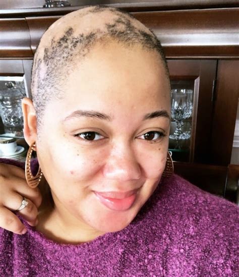 Pin on Hair | Alopecia Strong