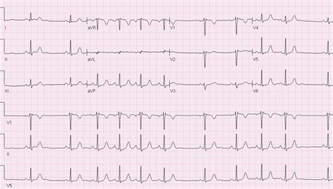 Sinus Arrhythmia ECG 1 | LearntheHeart.com