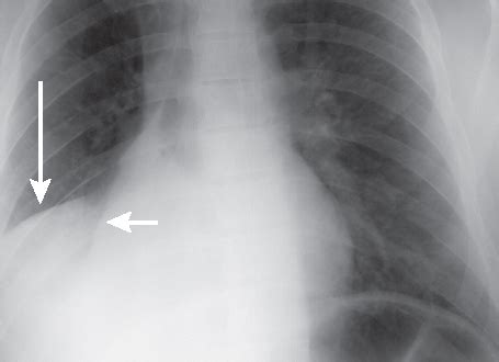 Middle Lobe Syndrome Symptoms, Causes, Diagnosis, Treatment