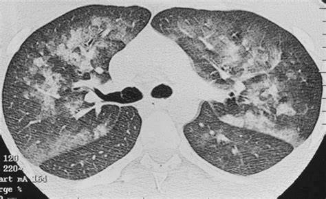 Clinical and Radiologic Features of Pulmonary Edema | RadioGraphics