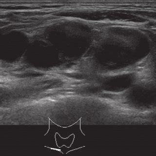 Lymph Node Hilum Ultrasound