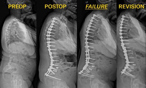 Evaluating Pelvic Fixation in Adult Spinal Deformity Surgery - Advances ...