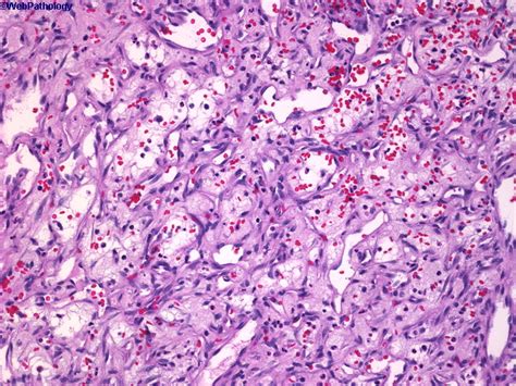 Webpathology.com: A Collection of Surgical Pathology Images