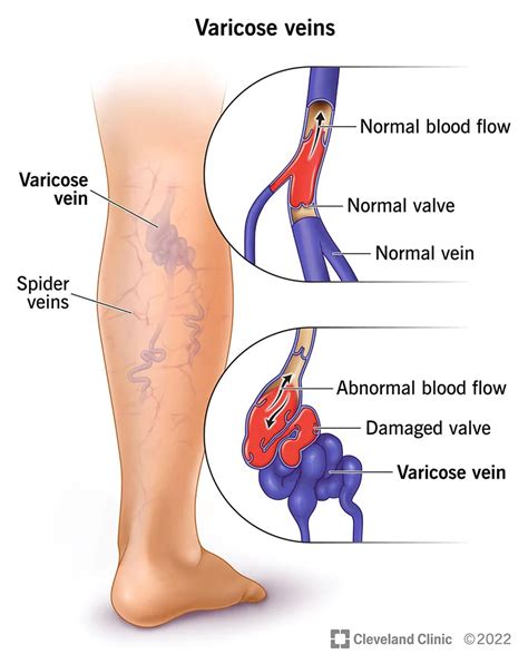 Varicose Vein Treatments - What are the Best?