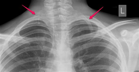 Bilateral cervical ribs - SHIVI X-Ray And Ultrasound Centre (SHIVI ...