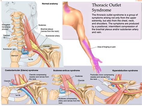 Cervical Rib(Thoracic Outlet Syndrome):Overview,Diagnosis & Treatment ...