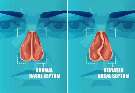 Septoplasty and Turbinate Reduction - SinusHealth