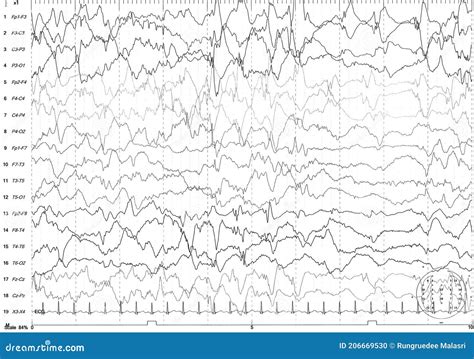 Abnormal eeg - watchergawer