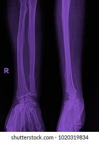 Xray Hand Fracture Stock Photo 1020319834 | Shutterstock