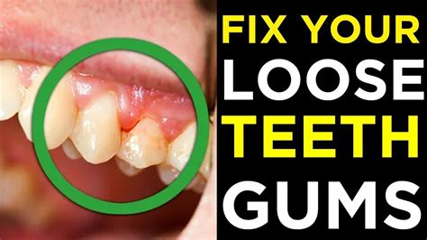 FIX YOUR LOOSE TEETH and GUMS | Amazing Home Remedies To Fix Loose And ...