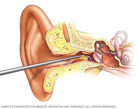 Earwax blockage - Diagnosis and treatment - Mayo Clinic