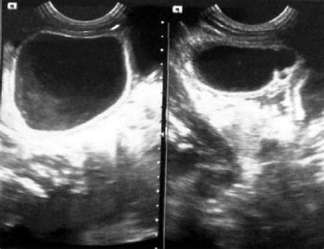 Ultrasound showing thick walled enteric duplication cyst | Download ...