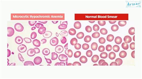 hypochromic microcytic anemia dx – causes of microcytic hypochromic ...