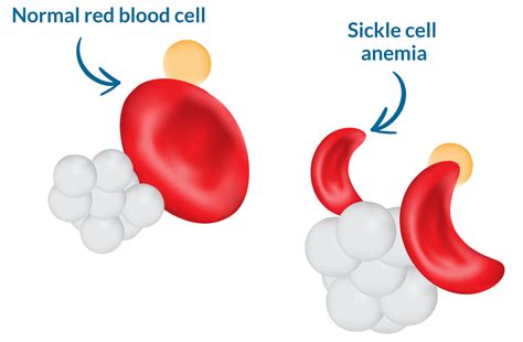 Sickle cell anemia – AAFC