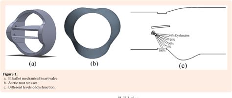 Figure 1 from Hemodynamics of a bileaflet mechanical heart valve with ...