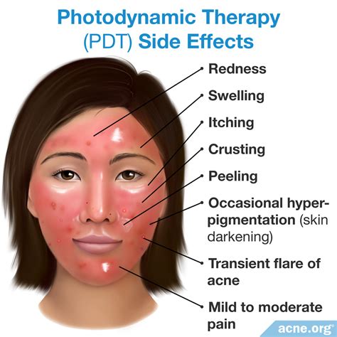 Photodynamic Therapy - PDT - Acne.org