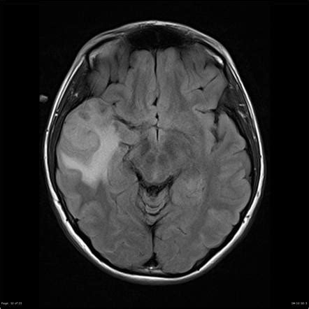 Pleomorphic xanthoastrocytoma | Image | Radiopaedia.org