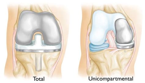 Partial Knee Replacement Surgery - Considerations, Suitability, And Costs