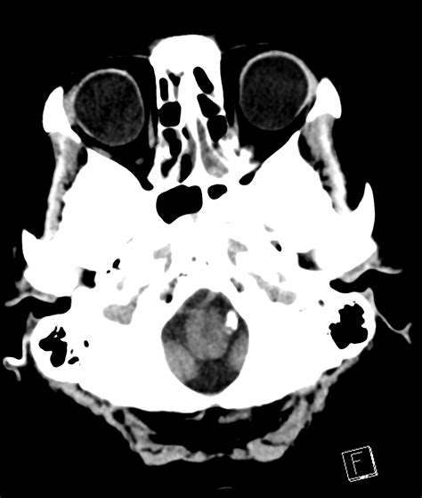 Staphyloma | Image | Radiopaedia.org