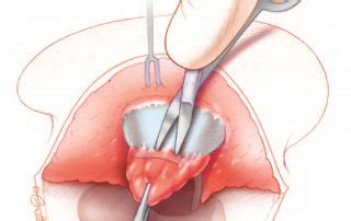 Postauricular Meatoplasty – Oto Surgery Atlas