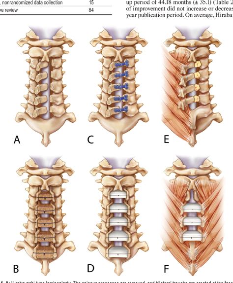 Figure 1 from Cervical laminoplasty developments and trends, 2003-2013 ...