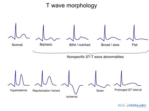 T wave - wikidoc