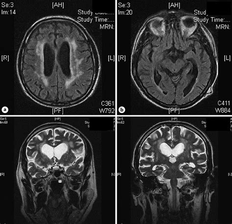 Head MRI scan illustrating vascular encephalopathy and global brain ...