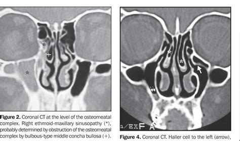 Figure 2 from THE ROLE OF OSTEOMEATAL COMPLEX ANATOMICAL VARIANTS IN ...