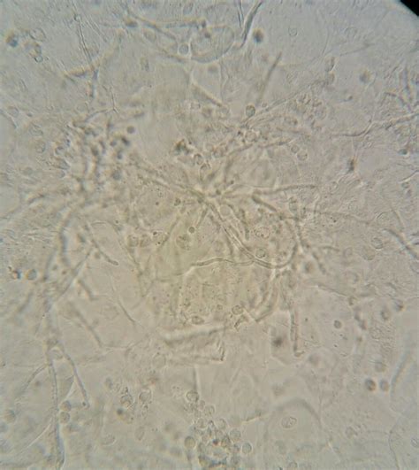 Fungi in the urine test (GUE) | Medical laboratory, Medical laboratory ...