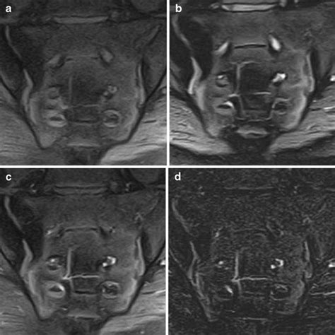 (PDF) Evaluation of sacroiliitis: Contrast-enhanced MRI with ...