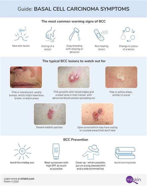 Basal Cell Carcinoma - Symptoms, Types and Pictures