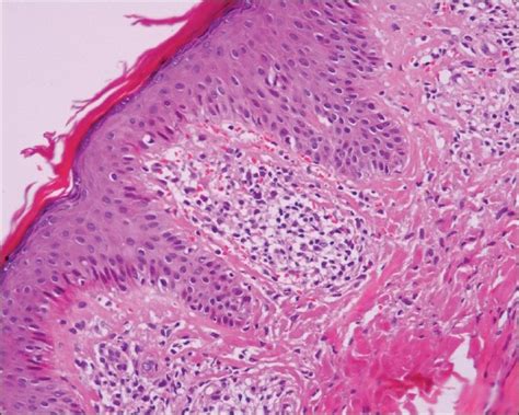 Eczematous Dermatitis Histopathology