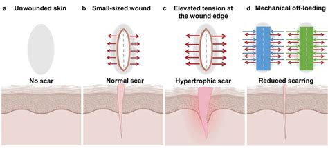 The presence of mechanical tension across skin wounds worsens scarring ...