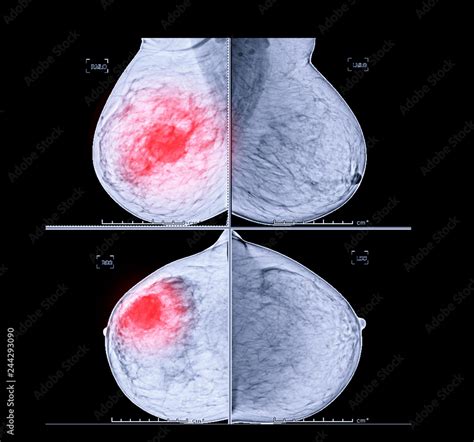 X-ray Digital Mammogram both side CC view and MLO . mammography or ...