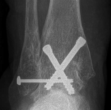 Postoperative arthroscopic ankle arthrodesis radiograph. | Download ...