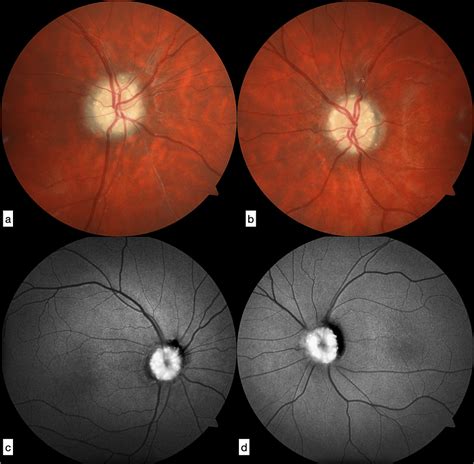 Optic Disc Drusen (ODD), an Often Misdiagnosed Disease: A Case Report ...