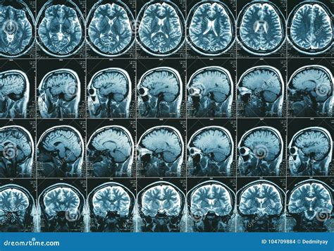 MRI Scan Or Magnetic Resonance Image Of The Brain Showed Obstructive ...