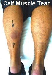 Calf Muscle Pain: Causes, Diagnosis, Symptoms & Treatment