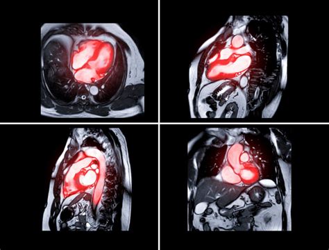 How Cardiac Arrhythmia Can Affect Your Body: Symptoms and Causes - CVRTI