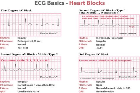 Heart block causes, symptoms, types, diagnosis and heart block treatment