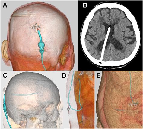 Frontiers | Reconsidering Ventriculoperitoneal Shunt Surgery and ...