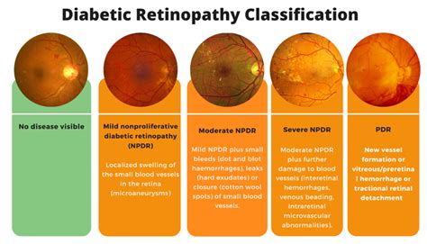 Diabetic Retinopathy classification - MEDizzy