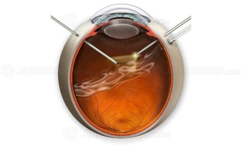 Pars plana vitrectomy - #SUVR0021 - Stock eye images