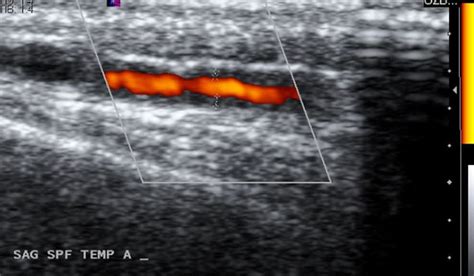 Temporal Arteries Ultrasound