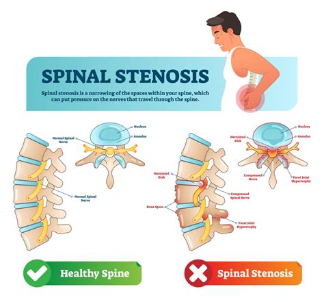 CNS Neurosurgery | Spinal Stenosis - S. JAVEDAN MD