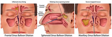 Sinuses Drained Surgically - Best Drain Photos Primagem.Org