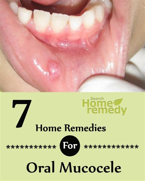 7 Home Remedies For Oral Mucocele | Search Home Remedy